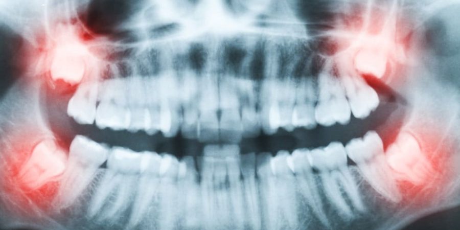 dental x-ray | oral surgery